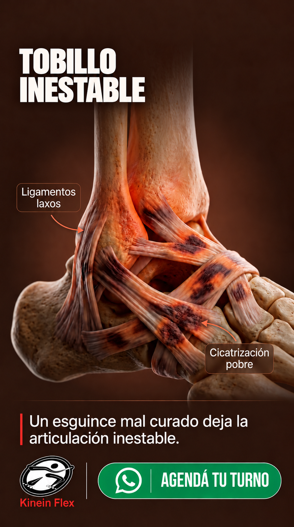 Publicación de Kinein Flex sobre inestabilidad de tobillo después de uno o varios esguinces